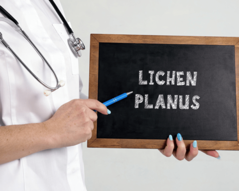 Lichen Planus