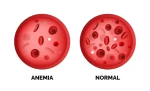 ANEMIA