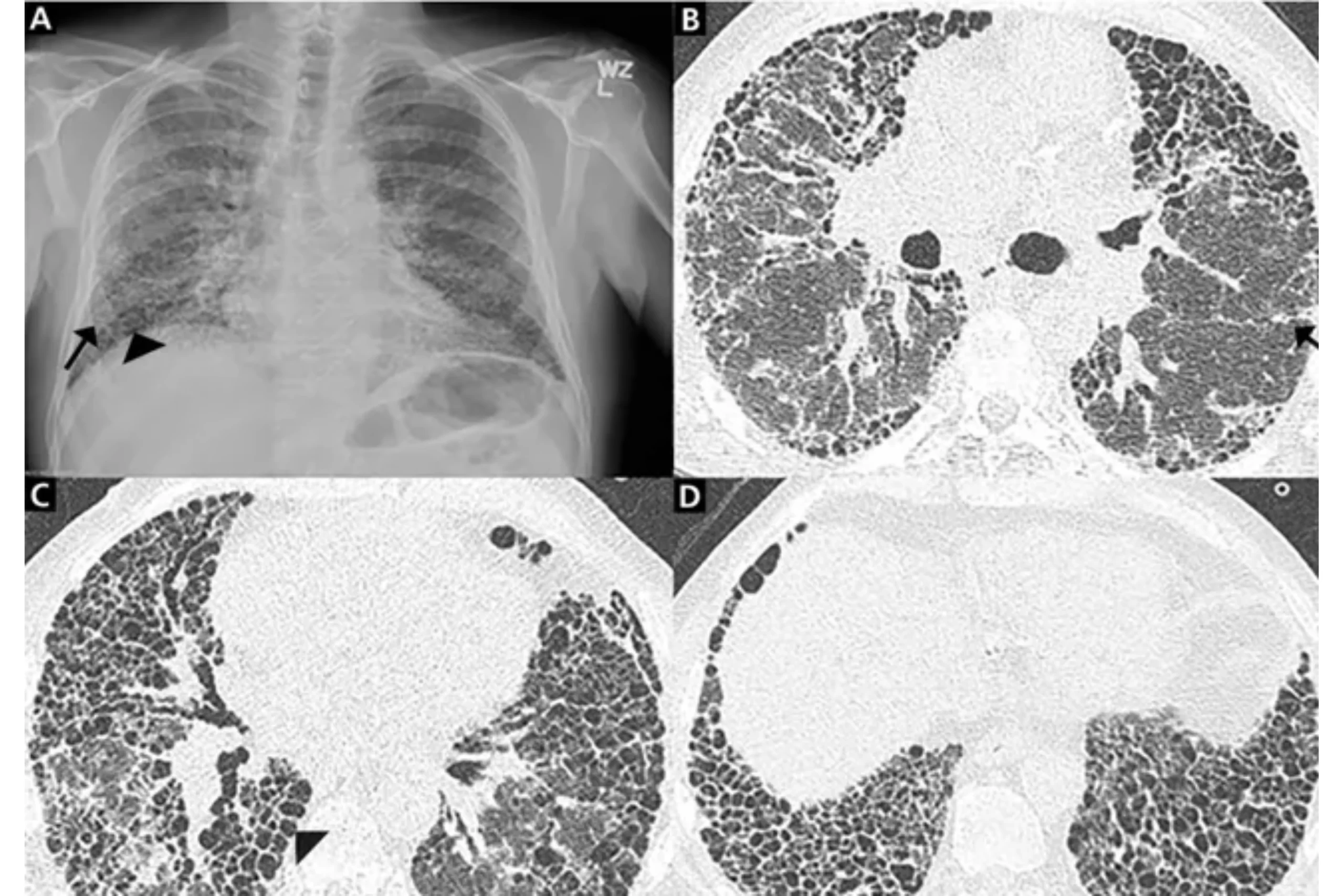 What is Idiopathic Pulmonary Fibrosis, the Cause of Tabla Maestro Zakir Hussain's Death?